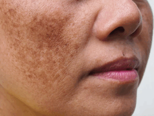 What causes pigmentation issues and how to treat them