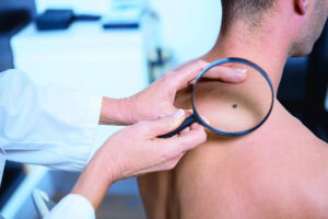 Cancer robs us of the most years