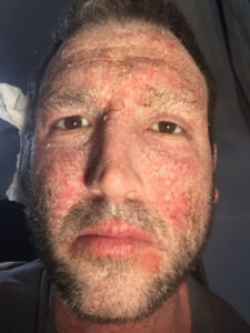 ‘Living through hell’: one man’s fight against topical steroid withdrawal