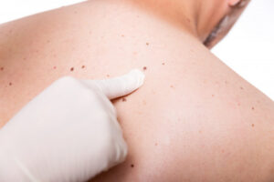 Check your skin