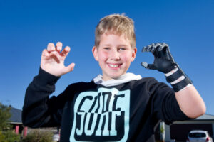 VIDEO: Bionic hand: Special donation a life-changer for Ajaih