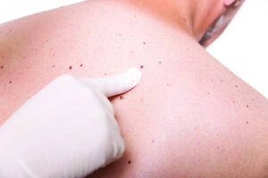 Early skin cancer detection is the key