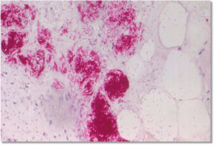 Flesh-eating infection spreads to Mallee