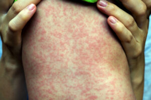 All urged to get vaccinated