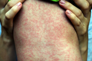Vax rollout with measles on the rise